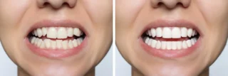 Porcelain Veneers before and after result
