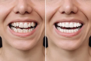 Porcelain Veneers before and after result
